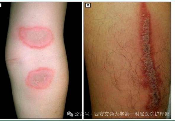 西安多区发现隐翅虫?千万别拍!毒液堪比硫酸